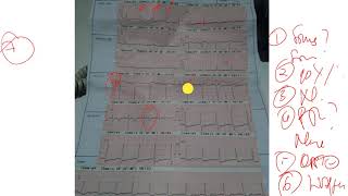 EKG pada Pasien NSTE-ACS.