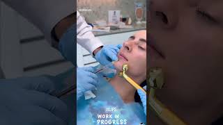 Lip Filler Treatment by Dr. Farshad at EDEN AESTHETICS Clinic Dubai | Enhancing Natural Beauty