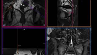 MR Lumbar Plexus - CISS Technique @ 3T