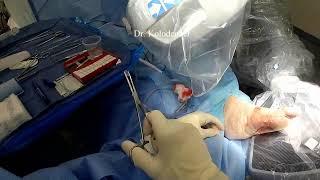 Removing a Large Piece of Glass from a Foot Under Live Fluoroscopy | Dr. Kolodenker