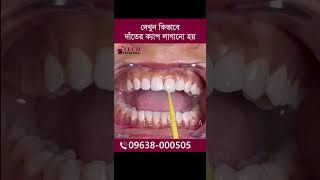 দেখুন কিভাবে দাঁতের ক্যাপ লাগানো হয় #dentist #viralvideo #trending #fyp #trendingshorts