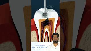 Root Canal Treatment and Tooth Abscess #shorts #youtubeshorts #medicalcollegevlog