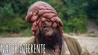 Me llaman "El Hombre sin Rostro" | Nacimos Diferentes | truly en Español