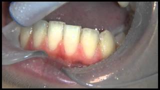 AquaCare Bioactive Glass and Ortho Resin Removal Without Damaging Teeth