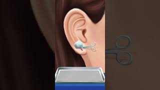 Cut Ear 👂 recover new surgery and Treatments