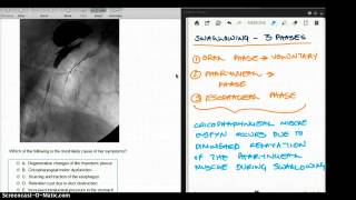 351 FA ZENKER DIVERTICULUM