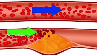 Ateroskleroz haqida ma'lumot #Ischanov #Lor  #Tibbiyot #Medoptimal #Anatomiya #ateroskleroz