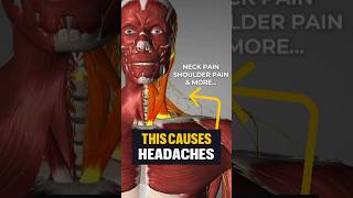 😩 Your headache could be due to weak muscles in the neck