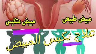 إليك الحل لتكيس المبيض?! .حلقة مفيدة جدا للانثى