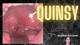 168.Peritonsillar abscess  #Quinsy #sorethroat #tonsillitis #abscess