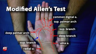 Modified Allen's test