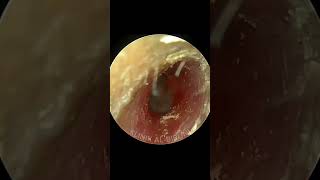 ONE SHOT Stone Hard Impacted Cerumen Removal (Most Satisfying Earwax Video)