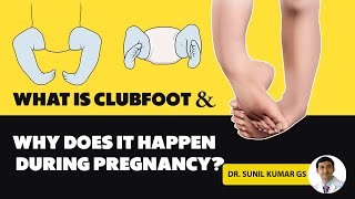 What is clubfoot & Why does it happen during pregnancy?| Dr. Sunil Kumar G S|#pregnancy  #clubfoot