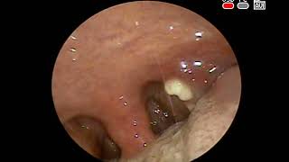 Хронический #тонзиллит диагностика лечение камни #миндалин #Tonsil #stone