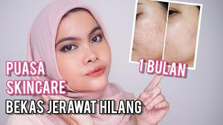 Mau Bekas Jerawat CEPAT Hilang? Diemin Aja