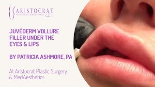 Juvéderm Vollure Filler Under Eyes & Lips Long Island, New York Aristocrat Plastic Surgery