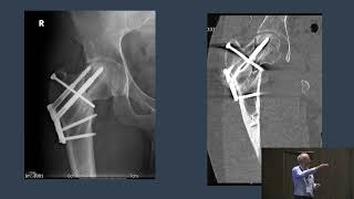 11 Monitoring and Optimization of changes in strain during treatment - Case Discussions