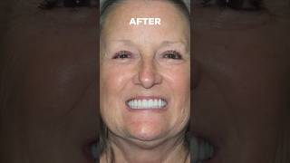 Incredible dental implants transformation for Colleen! #dentalimplants #newsmile