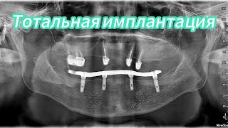 Тотальная имплантация и протезирование беззубой челюсти #рекомендации