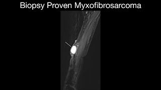 Biopsy Proven Myxofibrosarcoma