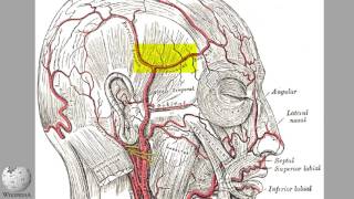 Fusiform Aneurysm of the Superficial Temporal Artery