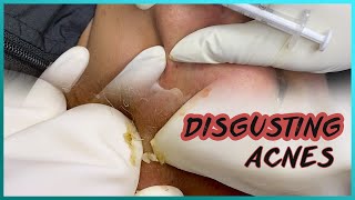 Big Cystic Acne Blackheads Extraction Blackheads & Milia, Whiteheads Removal Pimple Popping