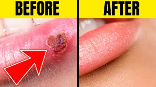 SIMPLE STEPS How to Get RID of IRRITATING Cold Sores !!