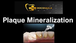 INBDE/NBDE PART-2-Dental Decks- Plaque Mineralization -Periodontics