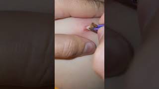 blackhead big