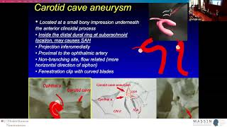 Clipping of Paraclinoid Aneurysms | MASSIN Congress Day 3 | Session 10, Talk 2