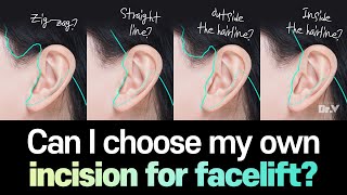 Facelift FAQ) Can I then choose my own incision for the facelift?