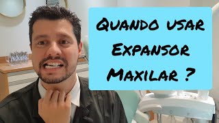 Quando usar aparelho expansor maxilar?