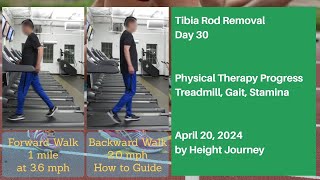 Tibia Rods Removal (Precice 2.2 Nails) - Day 30 after Surgery, Physical Therapy Progress