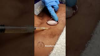 Plasma Rico en Plaquetas para acelerar recuperación de quemadura #avefenixestetic