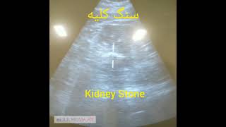 kidney Stone ESWL