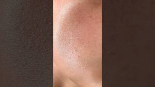 How to get rid of Textured/Bumpy Skin | #tiktok #shorts #skincare #viral #acne