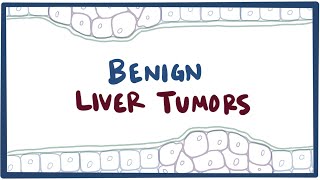 Benign liver tumors - causes, symptoms, diagnosis, treatment & pathology