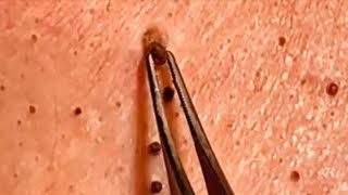 Biggest Blackheads!  V2