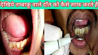 मसूड़े से खून या सूजन होने का इलाज/masudo me sujan aur dard ka ilaj