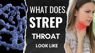 Understanding Strep Throat: What it Looks Like and How to Identify Symptoms