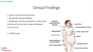 5 Cushing syndrome