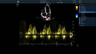 〖Echocardiography〗 Measuring - the pulmonary veins signal TTE