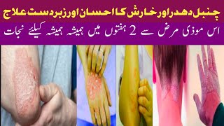 Chambal کا shafi ilaj| psoriasise ka treatment home remedy| Dr mushtaq Ahmad|