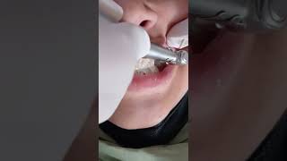 teeth polish 😬 #beauty #dentalbraces #dentalesthetics #dentistry #satisfying #dentalcare #dentition