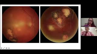 Atenção Oftalmológica no Pronto Atendimento - 4ª aula - doenças da retina, coroide e nervo óptico