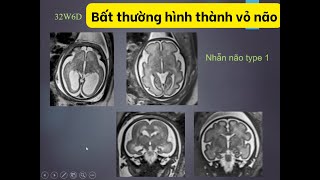 Tiếp cận bất thường hình thành vỏ não thai nhi từ siêu âm đến MRI