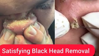 Satisfying Black Head Removal: Black Head Removal