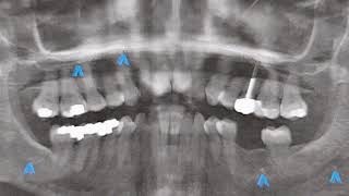 Growing 5 new teeth | XRAY SHOWS 5 DOTS  - I think i see my new wisdom teeth at the bottom