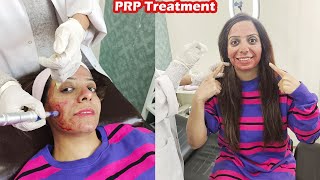 Face Treatment Vlog | PRP With Microneedling | AyeshaLifeStyle