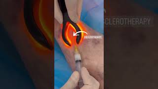 Sclerotherapy for Spider Vein Removal at EDEN Aesthetic Clinic Dubai | Instant Results